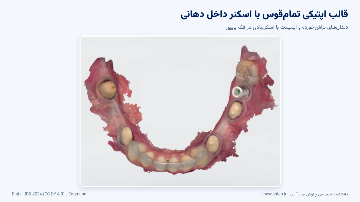 قالب اپتیکی اسکنر داخل دهانی از قوس فک پایین با دندان‌های تراش‌خورده و ایمپلنت دارای اسکن‌بادی